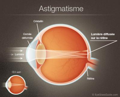astigmatism.jpg