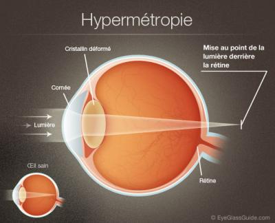 farsightedness.jpg